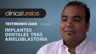 Juan Implantes dentales tras ameloblastoma Trailer [upl. by Divadnahtanoj]