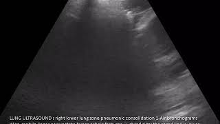 case 432 LUNG ULTRASOUND PNEUMONIA SHRED SIGN AIR BRONCHOGRAM REVERBATION [upl. by Anirtruc859]