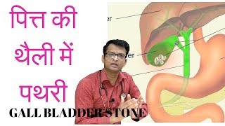 पित्त की थैली में पथरी  Gall bladder stone symptoms diagnosis treatment [upl. by Etterrag]