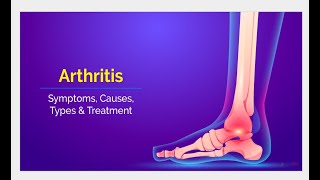 Arthritis Treatment arthritis arthritiscare arthritisrelief arthritissymptomstreatment [upl. by Arot]