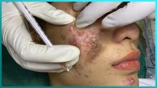 Big Cystic Acne Blackheads Extraction Blackheads amp Milia Whiteheads Removal Pimple Popping [upl. by Sill837]