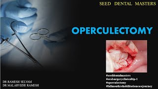 SEED DENTAL MASTERS  OPERCULECTOMY [upl. by Gildas]