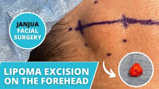 LIPOMA EXCISION ON THE FOREHEAD  DR TANVEER JANJUA  NEW JERSEY [upl. by Eenot]