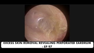 EXCESS SKIN REMOVAL REVEALING PERFORATED EARDRUM  EP 97 [upl. by Bonne]