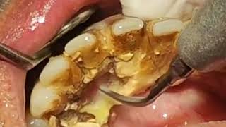 How to remove TARTAR from Teeth  Tartar removal before and after [upl. by Alekram733]