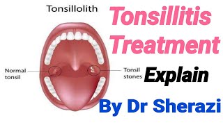 Homeopathic medicine for tonsils Tonsicare homeopathic medicine full explain in hindi urdu [upl. by Draneb101]