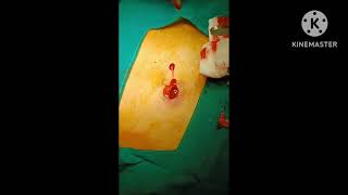 sebaceous cyst excision [upl. by Niwdog778]