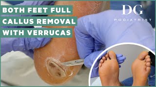 Callus removal from feet both feet and three verruca plantar warts treatment [upl. by Otrebliw]