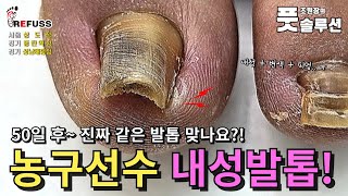 발목골절로 힘든데도 아파오는 내성발톱ㅠ 속시원한 첫관리후 50일만에 변화 확인하세요 조원장의풋솔루션 레푸스상도점 레푸스동탄역점 레푸스성남태평점 refuss 문제성발톱 [upl. by Oletta]