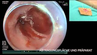 Karzinom im Barrett Ösophagus EMR und RFA [upl. by Mani]