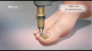 ClearChoice a dual laser approach to onychomycosis from Alma Lasers [upl. by Annaili]