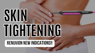 New Indications for Renuvion Device  Skin Tightening Procedure [upl. by Manvil]