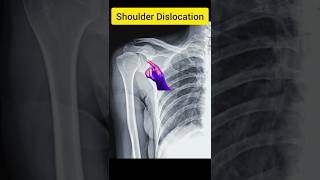 Shoulder Dislocation [upl. by Kegan]