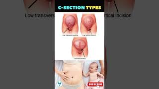 C Section Secrets Revealed ✅ Pregnancy Delivery option  Painless delivery option  Cesarean Section [upl. by Asilana]