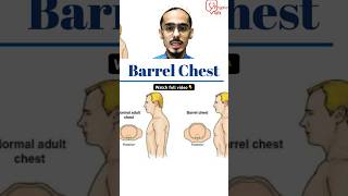 What is Barrel Chest Deformity shorts barrelchest chestdeformity [upl. by Helenka]