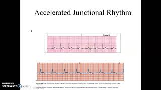 Accelerated Junctional and Junctional Tachycardia [upl. by Sidran]