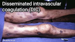 Disseminated intravascular coagulation  DIC  causes symptoms pathologydiagnosis treatment [upl. by Karleen]