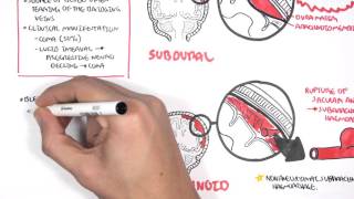 Intracranial Haemorrhage Types signs and symptoms [upl. by Slorac521]