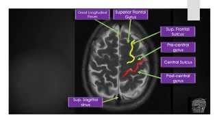 MRI Brain Sectional Anatomy Section 2 [upl. by Allista]