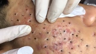 Big Cystic Acne Blackheads Extraction Blackheads amp Milia Whiteheads Removal Pimple Popping  612 [upl. by Eadrahs168]