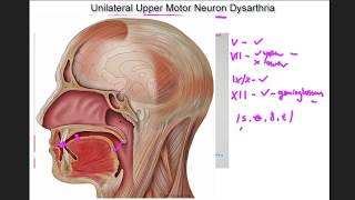 Unilateral Upper Motor Neuron Dysarthria  example and tutorial [upl. by Elatsyrc]