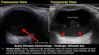 Eye Ultrasound Reporting  Cataract Retinal Detachments Vitreous Hemorrhage USG Case Reports [upl. by Tearle201]