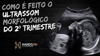 Como é feito o Ultrassom Morfológico de 2º Trimestre [upl. by O'Callaghan226]