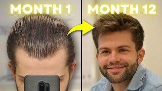 How I Regrew My Hair Using 3 Proven Treatments MonthbyMonth Results [upl. by Toni338]