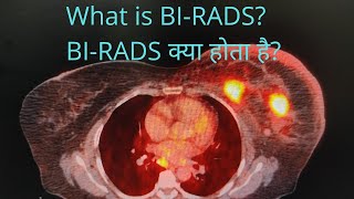 BIRADS क्या होता है What is BIRADS birads breastcancer petct fdg fdgpetscan petctscan [upl. by Yendis]