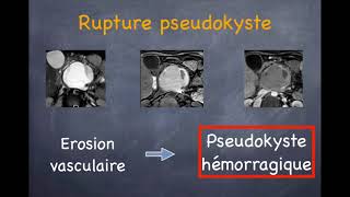 Pancréatite aiguë  4 Complications tardives [upl. by Kersten]