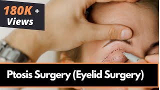 Ptosis Surgery Eyelid Surgery in Mumbai India by Best Oculoplastic Surgeon  Dr Debraj Shome [upl. by Dlanar919]