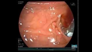 Primary Sclerosing Cholangitis and Brush Cytology Sampling [upl. by Atinauq]