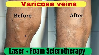 Varicose veins treatment  3 month follow up result Laser treatment  Foam Sclerotherapy treatment [upl. by Hutson]