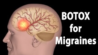 BOTOX for Migraines Animation [upl. by Dallis916]