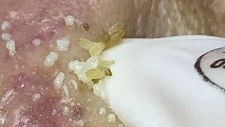 Acne treatment for Spa Linh Mun 2024 49 [upl. by Aissert306]