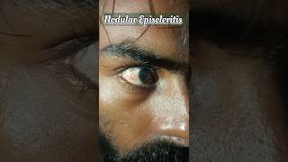 Noduler Episcleritis Live Demo Video nationalpandeyg eyecondition eyediseases [upl. by Ehrlich]