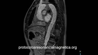 AORTA CIV SAG OBL [upl. by Jonie96]