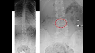 Lumbar Spine MRI Part 3 Scoliosis Spondylolisthesis [upl. by Schram879]