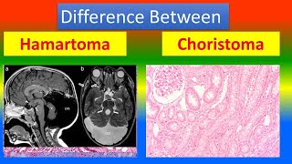 Difference between Hamartoma and choristoma [upl. by Frey]