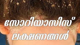 സോറിയാസിസ് ലക്ഷണങ്ങൾ  symptoms of psoriasis  Dr K V Shoyson  Arogyavicharam  TV Live Asia [upl. by Ainniz]