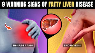 Fatty Liver at Diabetes Ano Bawal Kainin  Payo ni Doc Willie Ong 140 [upl. by Elamaj]