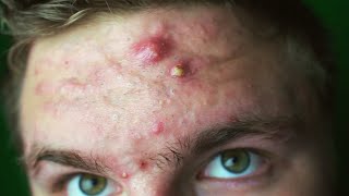 EVERY ACNE SUFFERER NEEDS TO SEE THIS  How To Get Past the Insecurity [upl. by Okier]