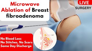 Microwave Ablation of Breast fibroadenoma  Non Surgical Treatment  Without Surgery [upl. by Eicats]