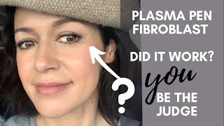 Fibroblast Plasma Pen  Does It Work YOU decide My 3 Month Before amp After Pics amp Videos [upl. by Ardnalac]