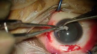 NO SUTURE NO GLUE PTERYGIUM EXCISION WITH AUTOGRAFT [upl. by Cioban706]