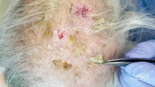 Debulking Lesions on the Scalp Erosive Pustulosis of the Scalp  CONTOUR DERMATOLOGY [upl. by Allisirp741]