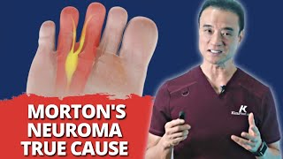 Everything You Know About Morton’s Neuroma Is WRONG Surprising True CAUSES Revealed [upl. by Alrad498]