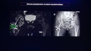 Epiphysiolyse fémorale proximale  Traitement chirurgical [upl. by Tracee322]