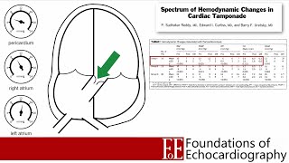 Level 1 Video Lecture Pericardial Effusions and Cardiac Tamponade [upl. by Leibman]