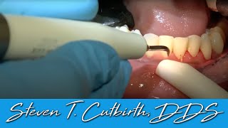 Treatment of periodontal disease  Scaling and root planing  Tartar © [upl. by Ilowell425]